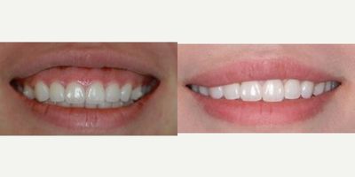 25-34 year old woman treated with lip lowering - This patient's gummy smile was treated with an upper lip lowering, resulting in a difference in thickness of upper lip, right and left areas, and the excessive display of gum tissue.