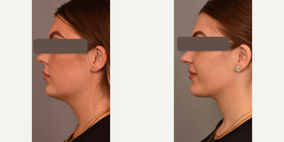 Woman treated with Mini Neck Lift - Woman treated with Mini Neck Lift