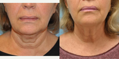 65-74 year old woman treated with Kybella - 67 year old female underwent Kybella injections.