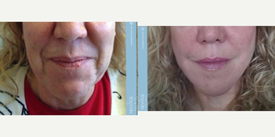 45-54 year old woman treated with Lower Face Lift - Lower face lift 1hour and 45 minutes surgery under general anesthesia. 2 nights in Hospital.