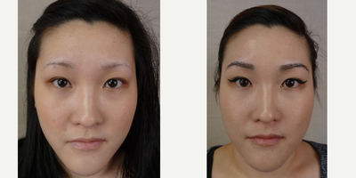 35-44 year old woman treated with Eyebrow Transplant - This is an eyebrow transplant patient of mine who received approximately 300 grafts per eyebrow.