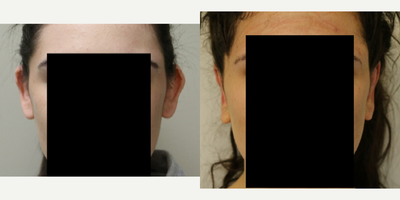 18-24 year old woman treated with Ear Surgery - 18-24 year old female treated with otoplasty.