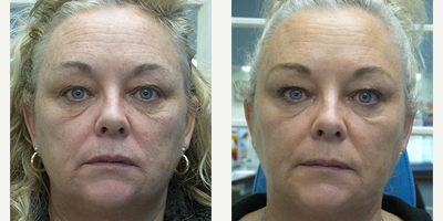 53 year old woman treated with Liquid Facelift - This patient wanted to freshen up her look. She had Botox, Juvederm, and Radiesse.
