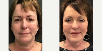 Woman treated with Facelift - Woman treated with Facelift, Neck Lift, and Eyelid Surgery.