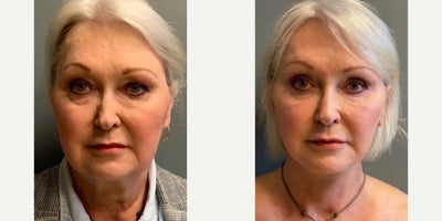 Woman treated with Facelift - Woman treated with Deep Plane Facelift, Deep Plane Neck Lift, Eyelid Surgery through upper and lower blepharoplasty, Brow Lift with Renuvion, Facial Fat Transfer through lipocube, and CO2 Laser Skin Resurfacing.