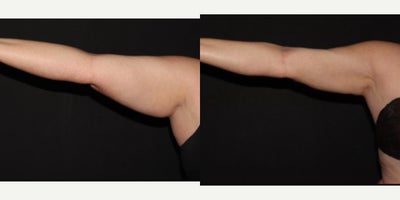 35-44 year old woman treated with Lipedema Surgery - Lipedema Reduction surgery to patients bilateral full arms