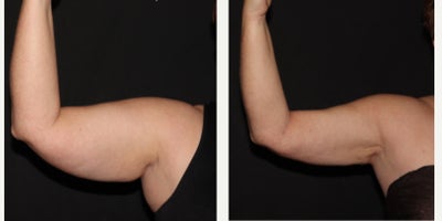 35-44 year old woman treated with Lipedema Surgery - Lipedema Reduction surgery to patients bilateral full arms