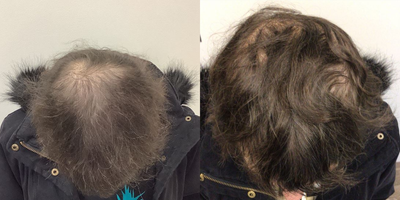 65-74 year old woman treated with PRP for Hair Loss - Almi and PRP's