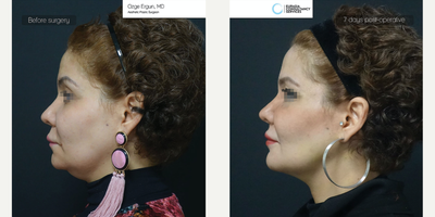 45-54 year old woman treated with Facelift, Neck Lift, Chin Implant - Facelift, Neck Lift,Chin Implant