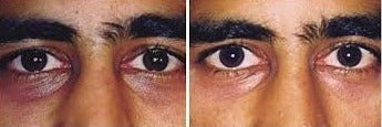 25-34 year old woman treated with Retin-A and vitamin K - i am asked many times how to treat dark circles. the only clinically proven method which is my original research is the use of retinol and vitamin K