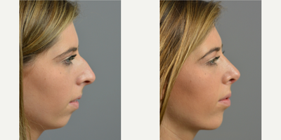 18-24 year old woman treated with Chin Implant - Patient presented with complaints of breathing difficulty bilaterally and concerns of overall size, shape of the nose as well as facial asymmetry.  After thorough examination, it was determined that a Chin Augmentation, Rhinoplasty, Septoplasty, Repair of Nasovestibular Stenosis and Bilateral Inferior Turbinate Outfracture and Cautery were in order.  Her results at 3 months post op reveal improved breathing, good nasal contours, septum midline &  nose midline, well healed columellar and chin scars with improved symmetry.