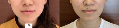 25-34 year old woman treated with Botox, Botox for TMJ - face slimming with botox in Asian patient