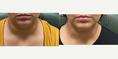 25-34 year old woman treated with Kybella - Before and after injection of 1 vial of kybella.