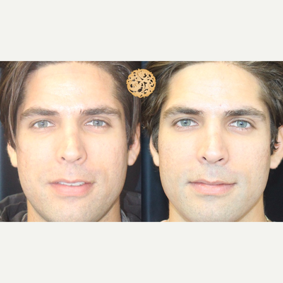 25-34 year old man treated with Vivace - Vivace can be used to treat rough texture, fine lines, wrinkles and depressed scars such as acne scars with superficial pigments.