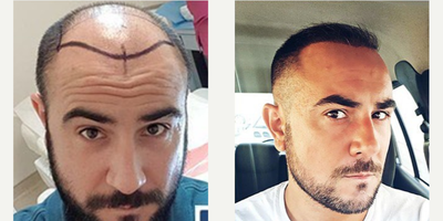 Man treated with Hair Transplant - After 4 months