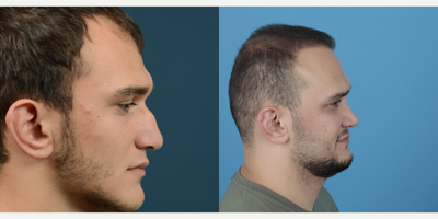 25-34 year old man treated with Rhinoplasty - Amazing change, amazing transformation