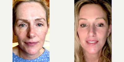 45-54 year old woman treated with Deep Plane Facelift, Neck Lift, Brow Lift, Facial Fat Transfer, TCA Peel, Dermabrasion, Lip Li - Deep plane facelift, extended neck dissection, deep neck contouring through submental incision, fat injection, endoscopic browlift, upper lip lift, 35% TCA peeling, perioral dermabrasion