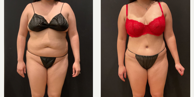 18-24 year old woman treated with Tummy Tuck, Brazilian Butt Lift, Liposuction - Tummy Tuck, BBL