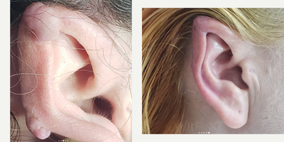Woman treated with Scar Removal Surgery - Woman treated with Scar Removal Surgery