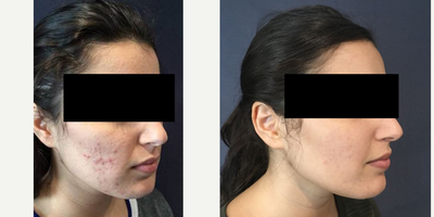 25-34 year old woman treated with Chemical Peel - Patient was treated with multiple chemical peels.