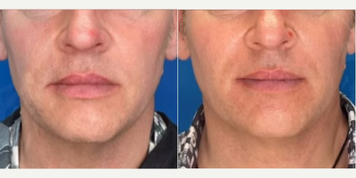 Man treated with Endolift - Man treated with Endolift.