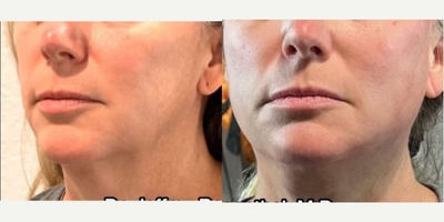 Woman treated with Endolift - Woman treated with Endolift.