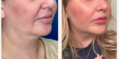 Woman treated with Endolift - Woman treated with Endolift.