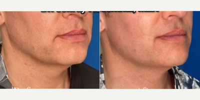 Man treated with Endolift - Man treated with Endolift.