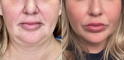 Woman treated with Endolift - Woman treated with Endolift.