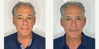 65-74 year old woman treated with Facelift, Neck Lift, Facial Fat Transfer, Eyelid Surgery - My 73 year old patient is 2 months post Facelift, Neck lift, Facial Fat Transfer and Upper Blepharoplasty.