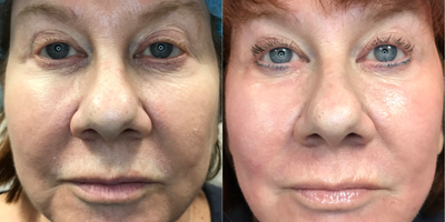 55-64 year old woman treated with Laser Resurfacing - Face resurfacing with J-Plasma ionized helium and radiofrequency.