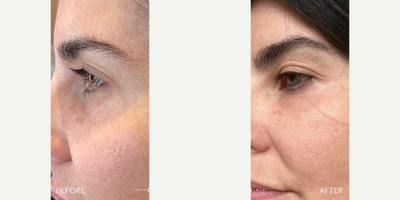 35-44 year old woman treated with PlasmaPen - 1 Month post PlasmaPen used to treat hollow, tired looking eyes.