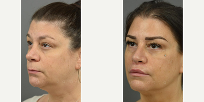 Woman treated with Revision Rhinoplasty - After getting great results from a rhinoplasty 8 months ago, our patient got a surgical lip lift. At just 6 weeks post-op.