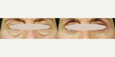 Woman treated with Facial Fat Transfer - We cant even try to hide the incredible results achieved by @drjamesmarotta on this Lower Blepharoplasty with Fat Transfer transformation