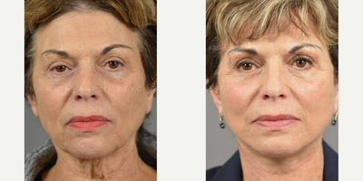 Woman treated with Facelift - The first facelift on record dates back to 1901. In the early days of facial plastic surgery, only the skin was addressed which left many with that pulled look that has been associated with the facelift for far too long. Facial Rejuvenation specialists, like Dr. James Marotta, are now using advanced techniques, like the Deep Plane Facelift, that include the SMAS, or muscle of the face, deep below the skins surface, to provide a subtle, natural result.This procedure is a fantastic option for restoring and rejuvenating a patient's complexion (without looking like they underwent major surgery). This is just one of the facial techniques Dr. Marotta offers to turn back the clock on a patient's appearance and create natural-looking results.