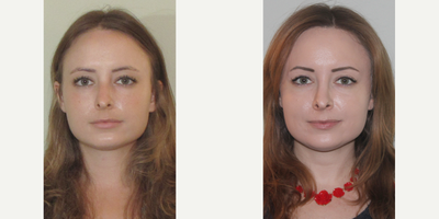 25-34 year old woman treated with Sinus Surgery - Female patient 4 months post op from turbinate reduction and septoplasty surgery.