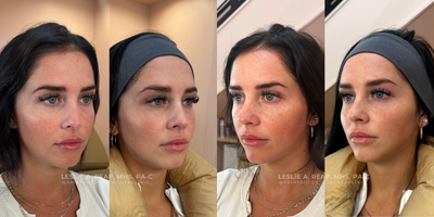 25-34 year old woman treated with Cheek Fillers, RHA Redensity - Before and after six weeks of cheek and undereye filler using RHA collection of fillers.
