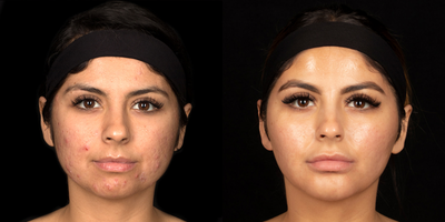 25-34 year old woman treated with Accutane - Woman treated with Accutane to rid her of severe cystic acne