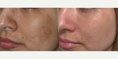 Los Angeles Laser treatment for cafe au lait birthmark removal. - It's not about vanity, but instead, confidence. When you have a cafe au lait birthmark like this one, it's not vain to want to have it removed. The time spent covering it up and explaining to others is enormous for our patients. And getting it removed is a tremendous relief. Call us today with questions about cafe au lait birthmarks. Before and after photos of laser birthmark removal in Los Angeles.