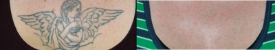 Laser tattoo removal - 
	Patient&#39;s chest before and after laser tattoo removal&nbsp;
