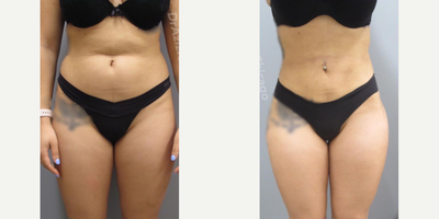 Woman treated with SAFELipo - Woman treated with SAFELipo for Lipo 360 and BBL. She had lipo around the midsection to tighten her waist and rounding of hips and buttocks.