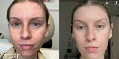 Woman treated with Halo Laser - Woman treated with Halo Laser