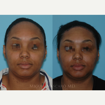 25-34 year old woman treated with Forehead Reduction - 1 week after hairline advancement, forehead shortening. In this case we advanced 3cm