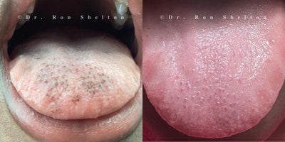 18-24 year old woman treated with Laser Peel - 24 year old woman treated with Ruby laser for tongue pigmentation