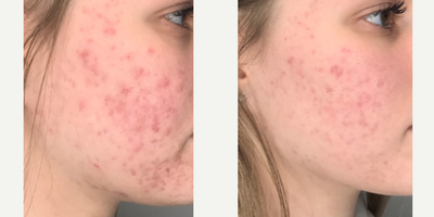 17 or under year old woman treated with Chemical Peel - This result is showing after just 2 PCAskin custom Chemical Peels! With a series of peels and cutting out dairy/sugar as much as possible from her diet along with some medical grade skincare, her progression will continue to improve.