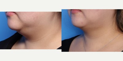 25-34 year old woman treated with FaceTite - 30 year old female shown 6 months after FaceTite liposuction to her neck/lower face. She had a nice reduction in her neck profile and to her jowls.