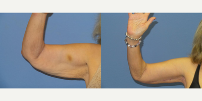75 year old woman treated with Arm Lift - 75 y/o female who is shown 6 months after a brachioplasty and tummy tuck. She used Embrace scar therapy to both areas.