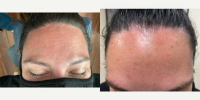 25-34 year old woman treated with ThermiSmooth Face - 25-34 year old woman treated with six sessions ofThermiSmooth Face shown 2 weeks post op.The 1st photo is after her 2nd session and the 2nd photo is after her 6th session.