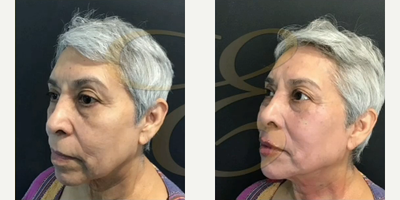 Woman treated with Restylane Lyft, Botox - Woman treated with Restylane Lyft, Botox