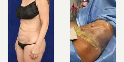 Woman treated with Tummy Tuck, Liposculpture - Woman treated with Tummy Tuck, Liposculpture